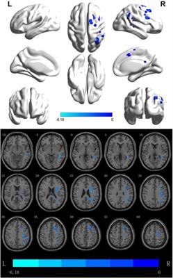 Study on Low-Frequency Repetitive Transcranial Magnetic Stimulation Improves Speech Function and Mechanism in Patients With Non-fluent Aphasia After Stroke